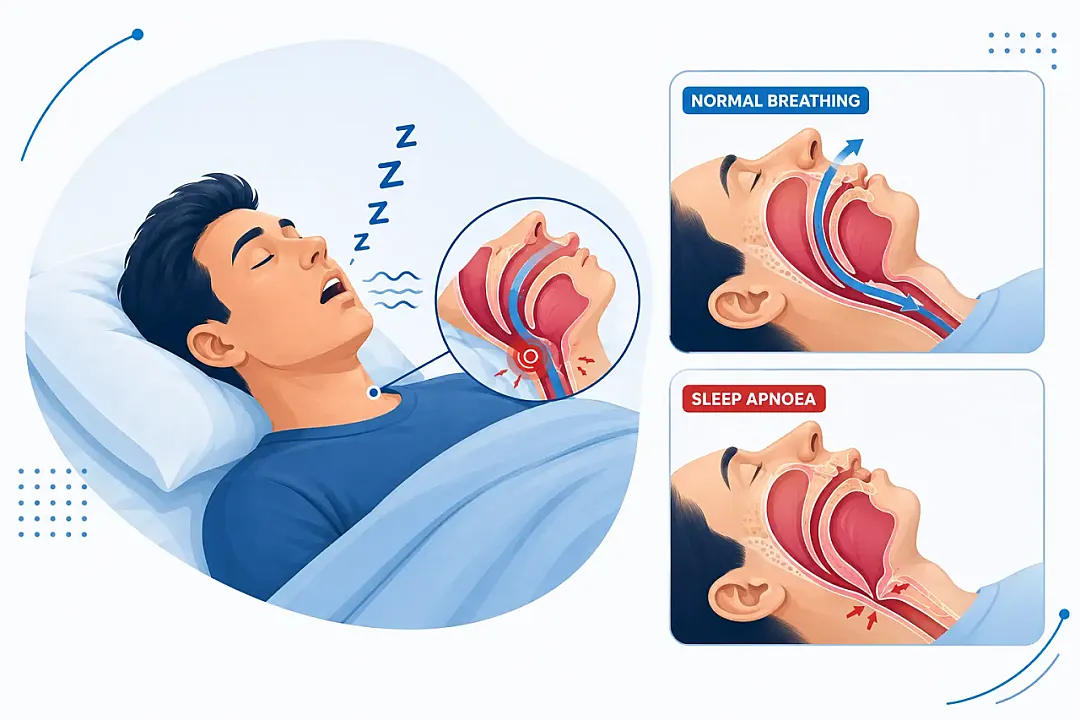 Sleep Apnoea